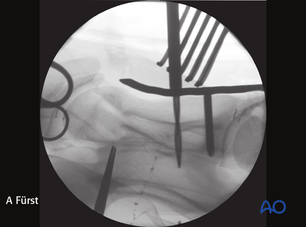plate fixation