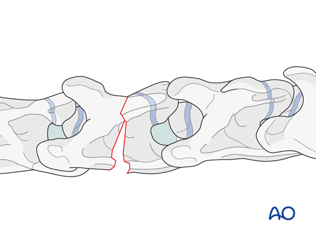 plate fixation