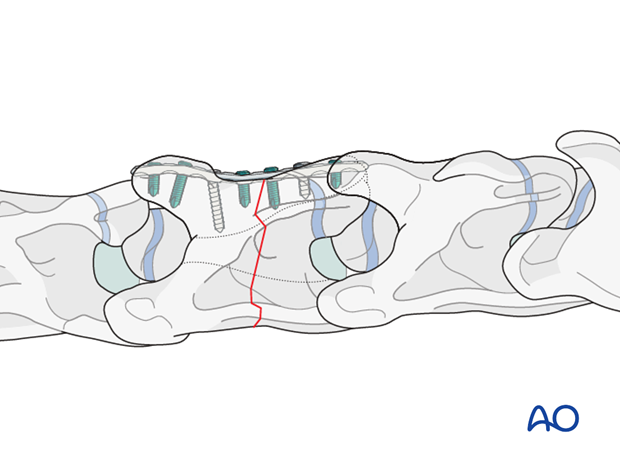 cervical c3 c7 vertical body