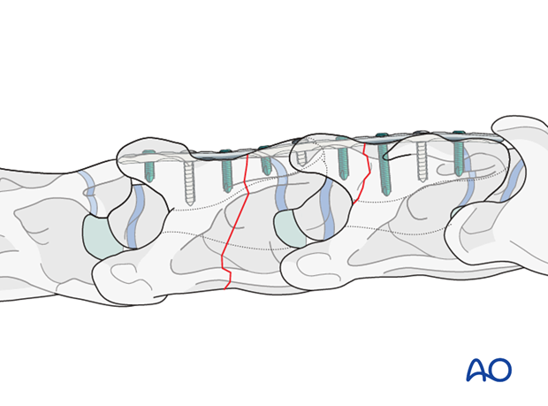 plate fixation