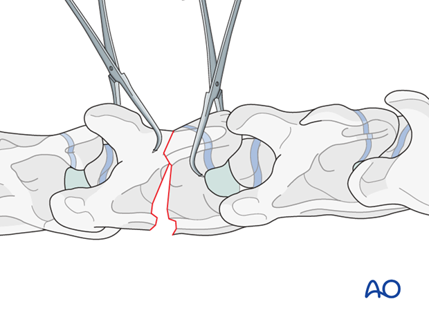 plate fixation