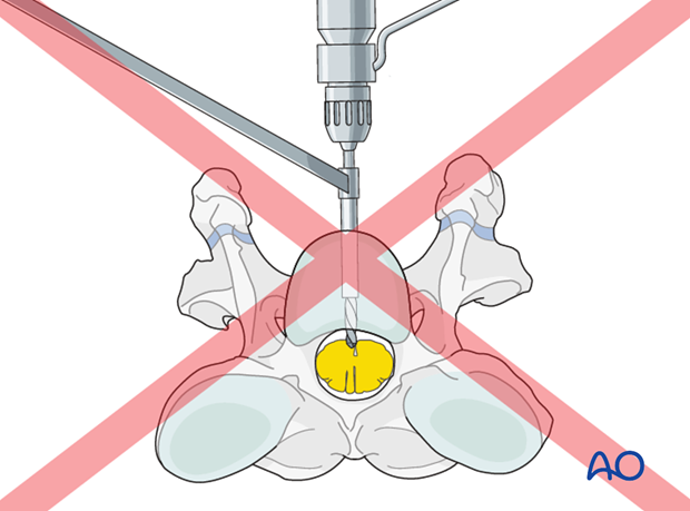 plate fixation