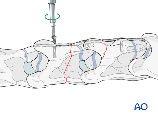 plate fixation