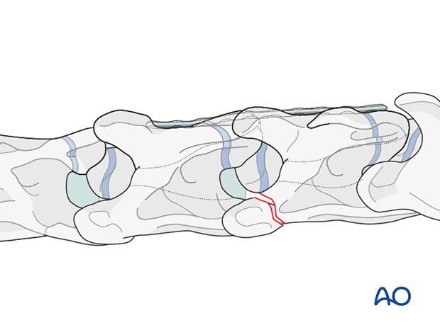 h50_P131_i060 plate fixation