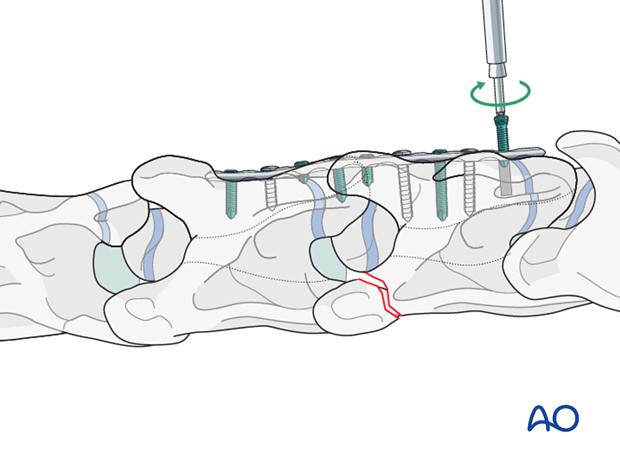 h50_P131_i120 plate fixation