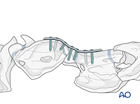 cervical subluxations