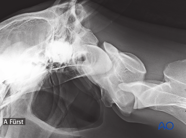 h50_P151_p00 arthrodesis with plates