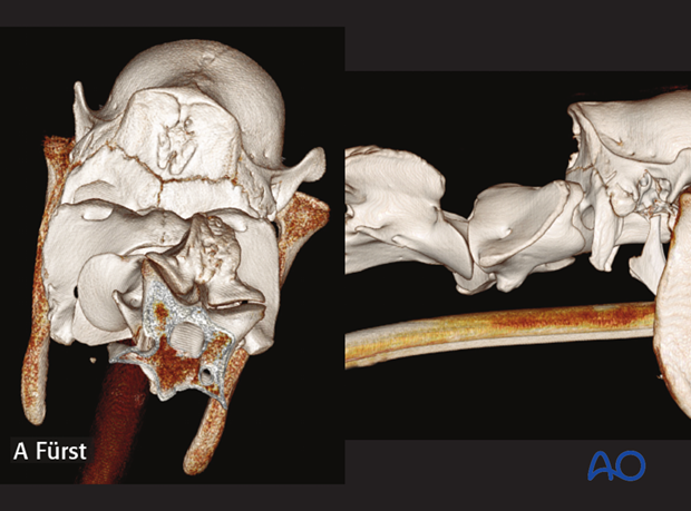h50_P151_p01 arthrodesis with plates