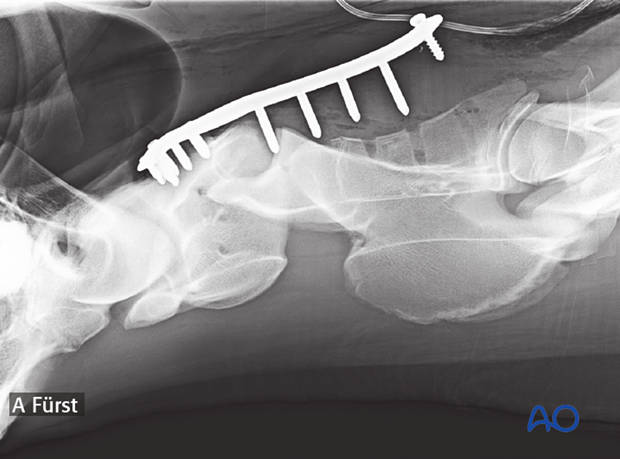 h50_P151_p02 arthrodesis with plates