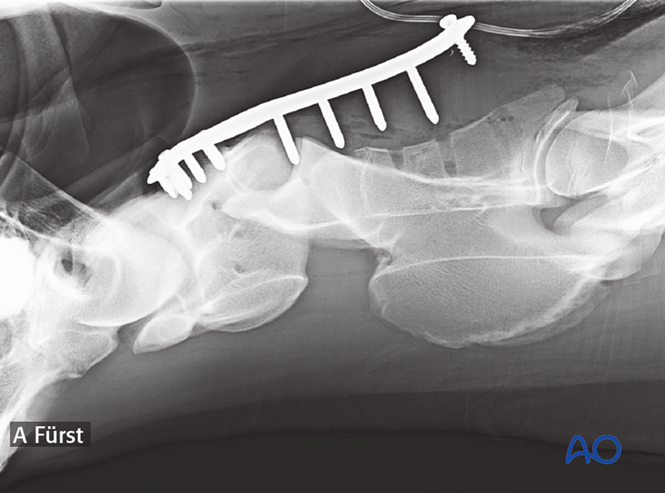 Arthrodesis with plates for Cervical subluxations