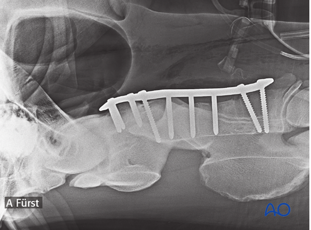 h50_P151_p03 arthrodesis with plates