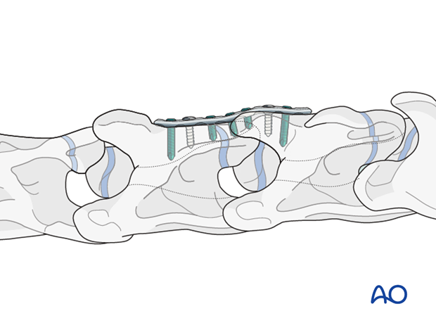 cervical instability