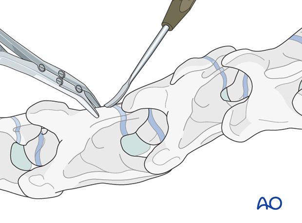 arthrodesis with kerf cut cylinder