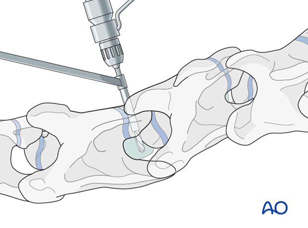 arthrodesis with plates