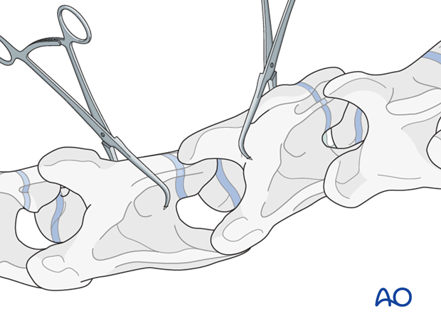 arthrodesis with plates