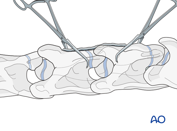 arthrodesis with plates