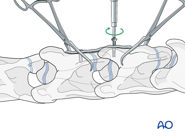 arthrodesis with plates