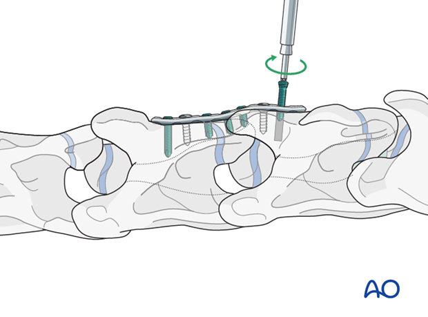 arthrodesis with plates