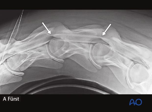 arthrodesis with kerf cut cylinder
