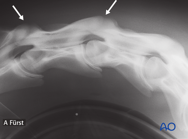 arthrodesis with plates