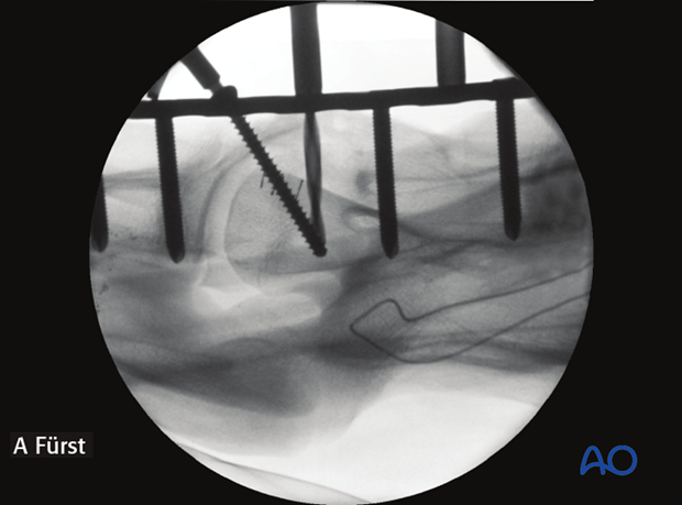 arthrodesis with plates