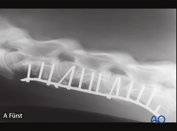 arthrodesis with plates