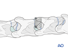 cervical instability