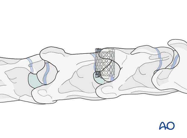 cervical instability