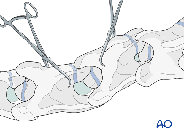 arthrodesis with kerf cut cylinder