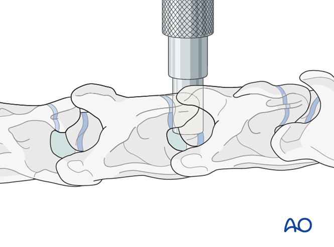 Arthrodesis with Kerf-cut cylinder for Cervical instability