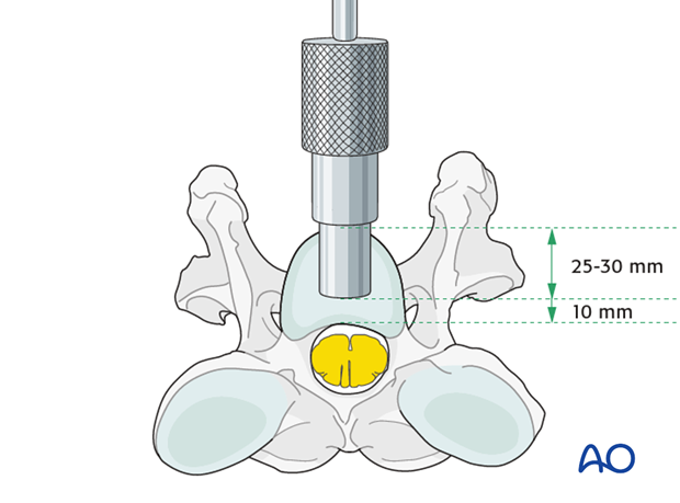 arthrodesis with kerf cut cylinder