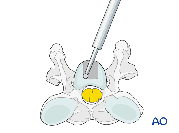 arthrodesis with kerf cut cylinder