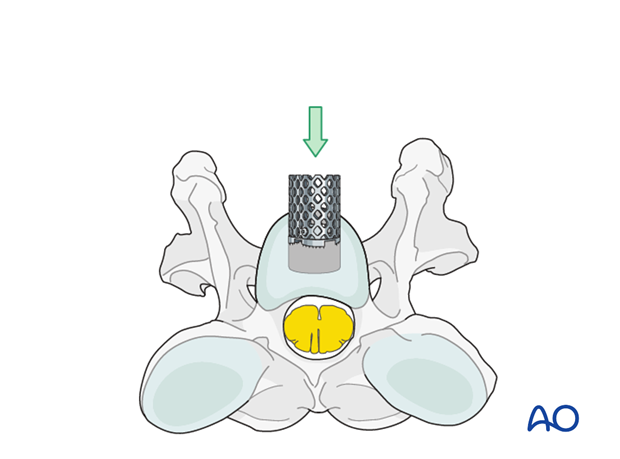 arthrodesis with kerf cut cylinder