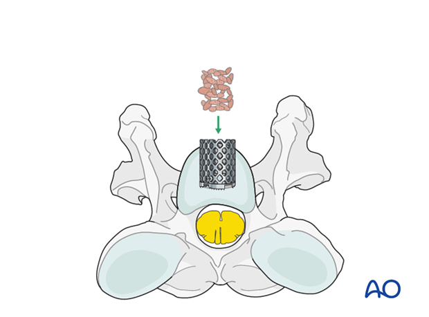 arthrodesis with kerf cut cylinder