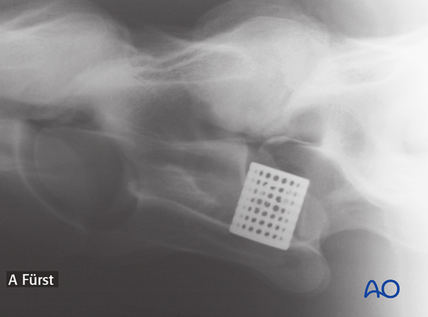 arthrodesis with kerf cut cylinder