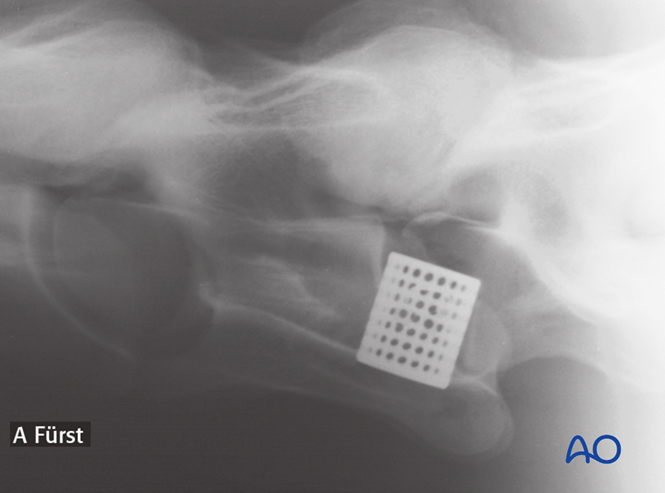 Arthrodesis with Kerf-cut cylinder for Cervical instability