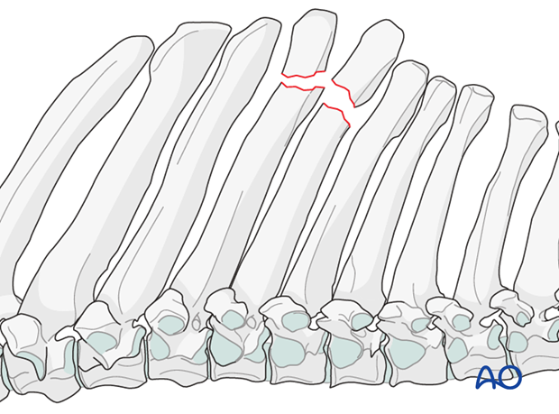 h50_P200_i020 resection