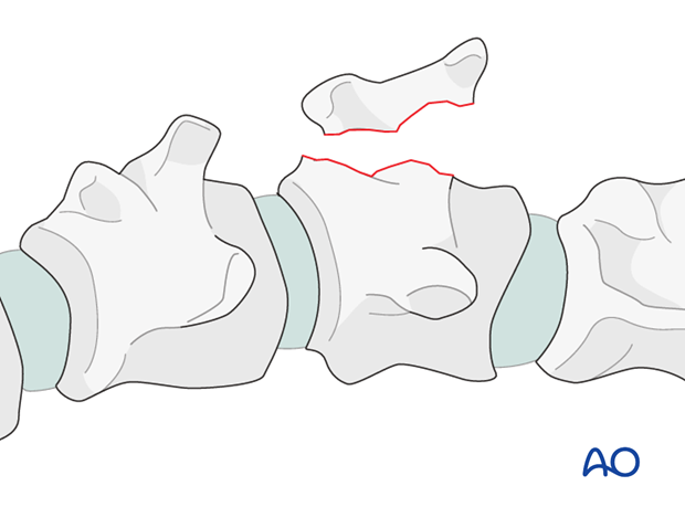 resection