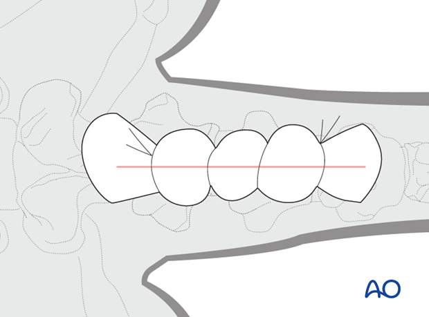 plate fixation