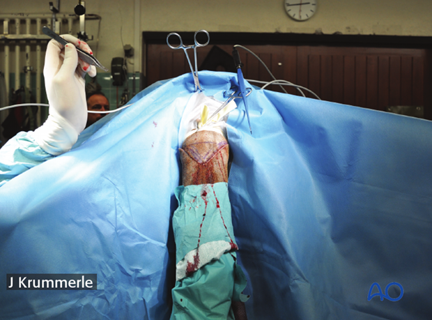 resection