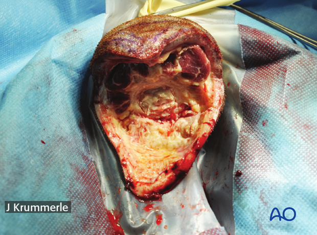 resection