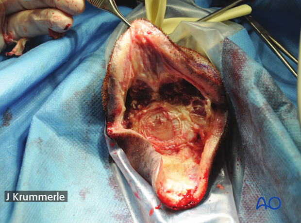 resection