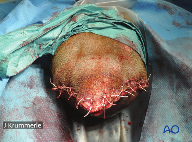 resection