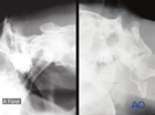 cervical c1 atlas
