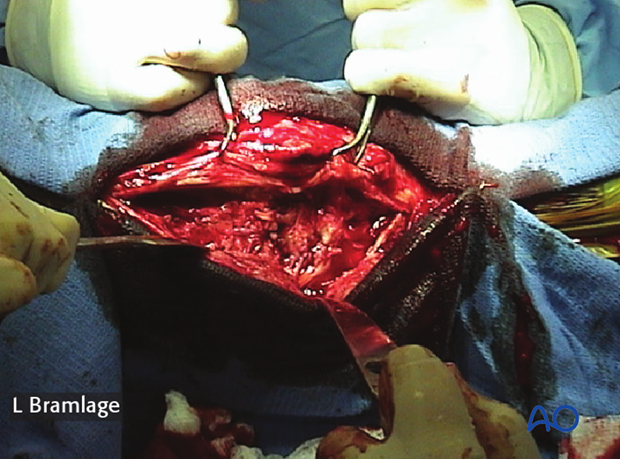 approach for pancarpal arthrodesis
