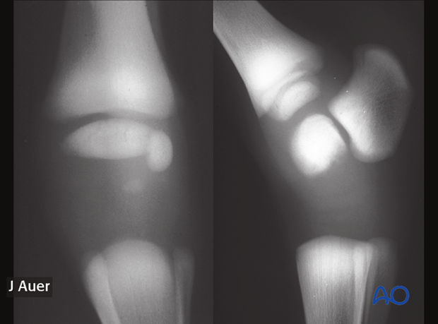 Dorsopalmar radiographic view of the carpus and lateromedial radiographic view of the tarsus of the smaller twin foal shown above. The cuboidal carpal and tarsal bones have not started to ossify.