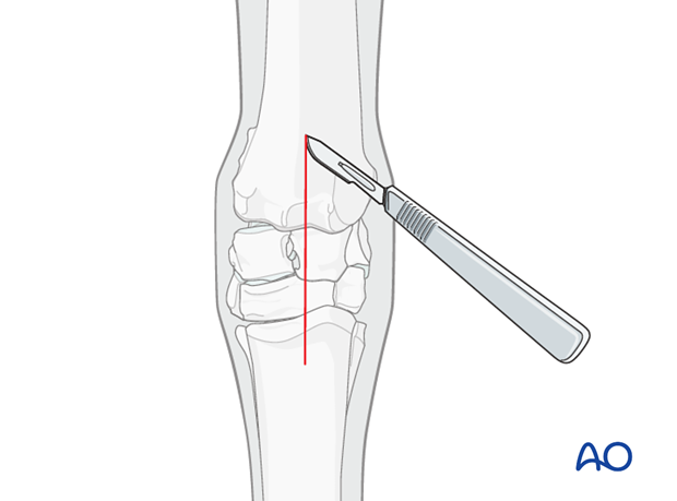 partial carpal arthrodesis