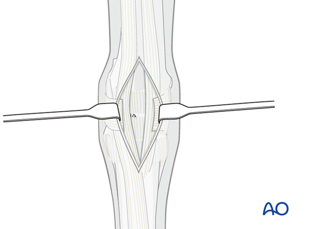 approach for pancarpal arthrodesis