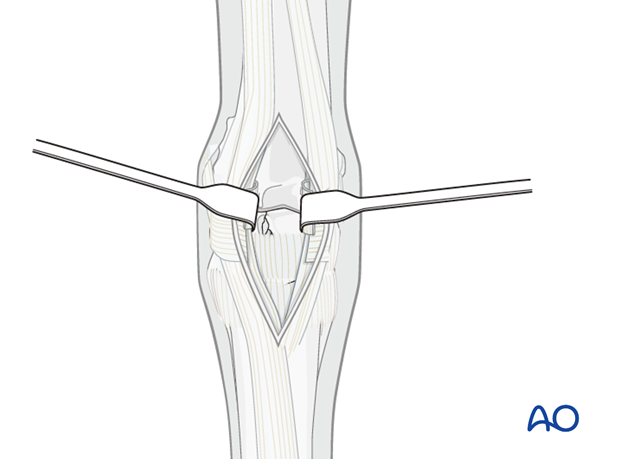 approach for pancarpal arthrodesis