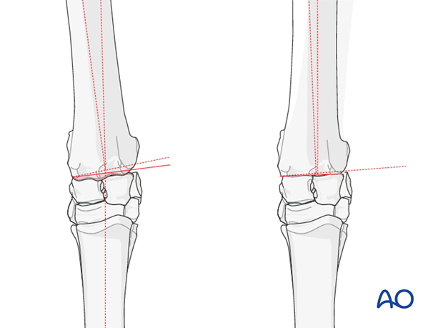 partial carpal arthrodesis